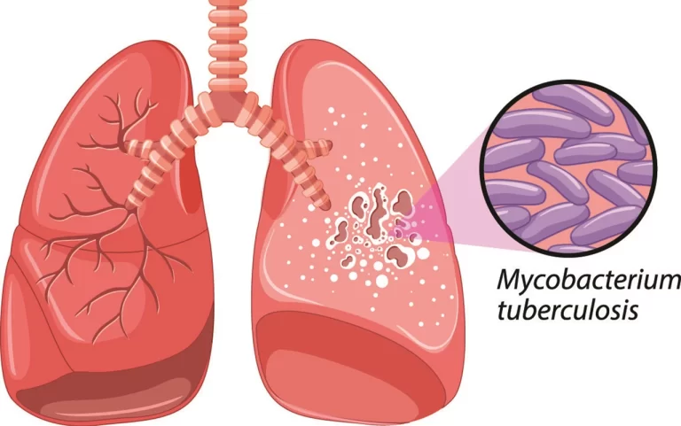 Causes of Tuberculosis