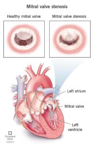 Mitral