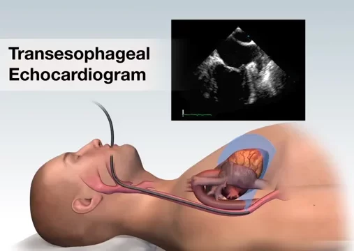 TEE ( Transesophageal Echocardiography )