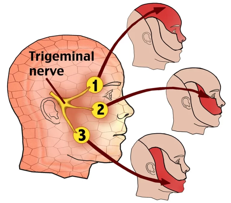 Understanding Trigeminal Neuralgia