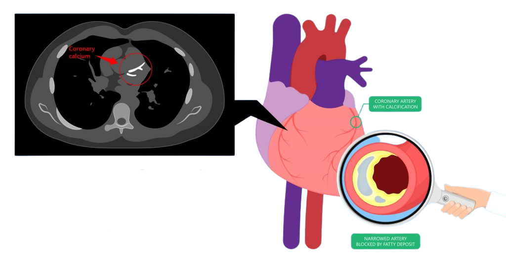 CT Calcium Scoring