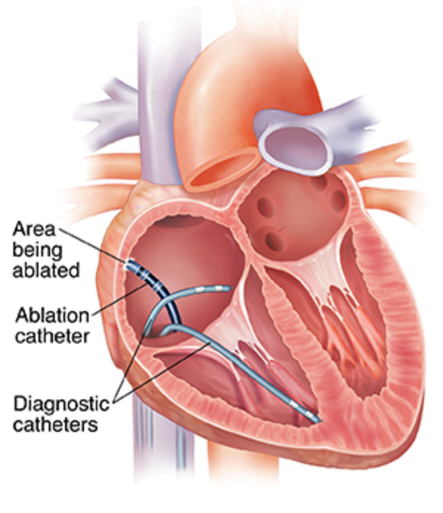 catheter ablation