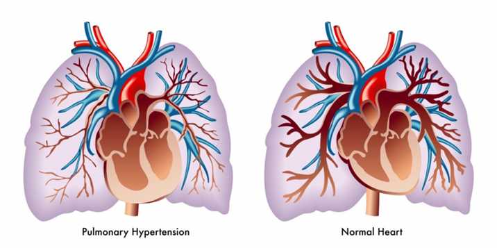 pulmonary hypertension