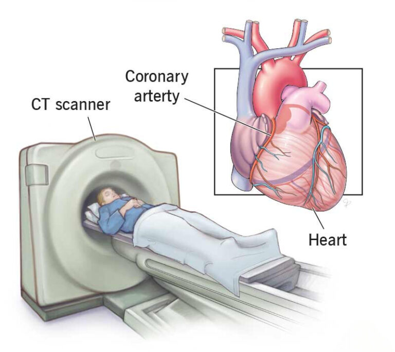 CT Coronary Angiography