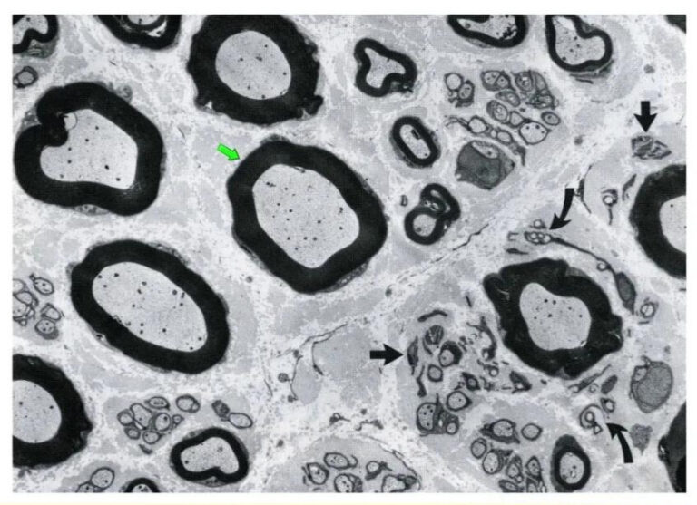 Peripheral Nerve Disorders