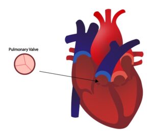 Pulmonary Valve Stenosis