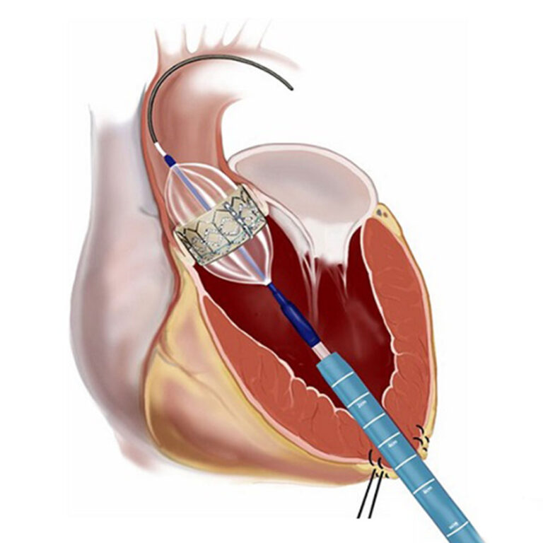 Balloon Pulmonary Valvotomy (BPV)