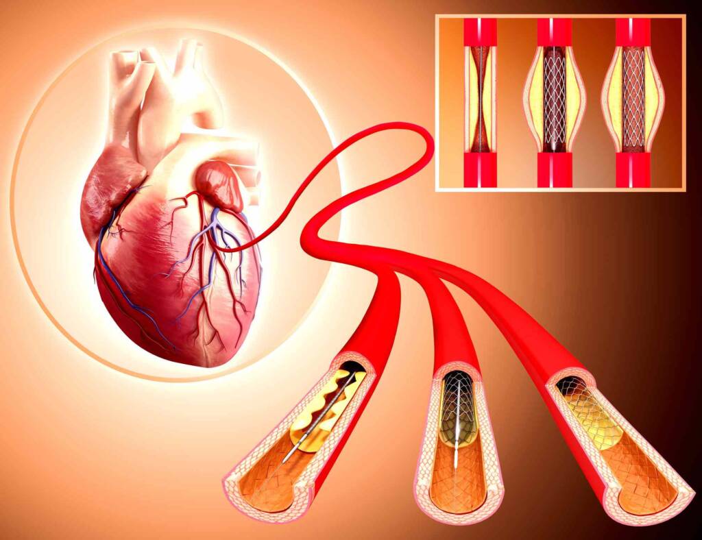 Peripheral Angiography and Angioplasty