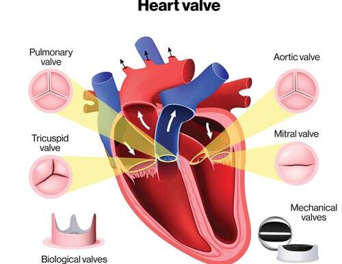 Valve Disease