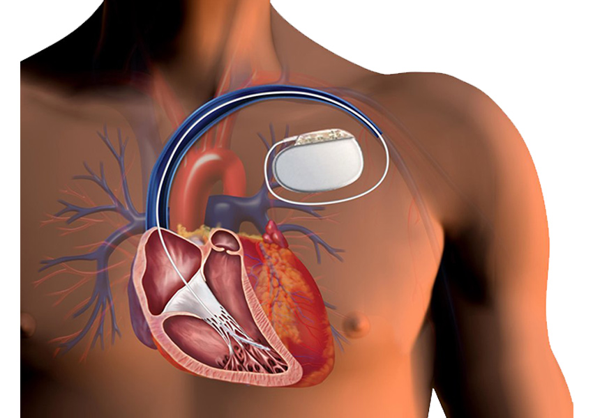 AICD and Pacemakers