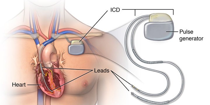 CRT-P and CRT-D Implantation procedure