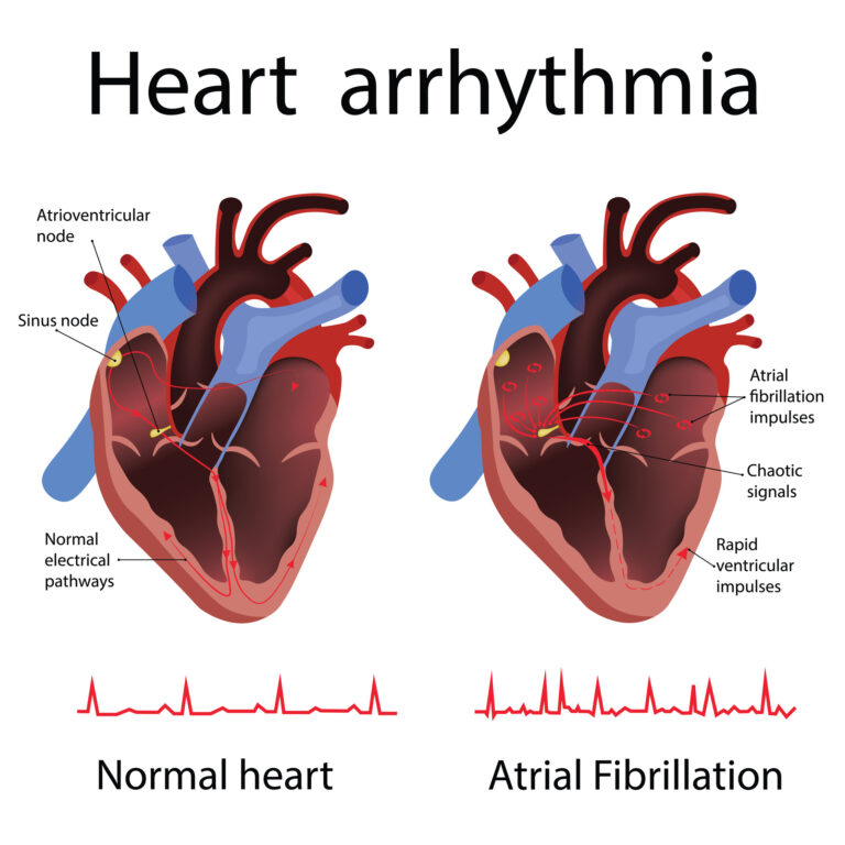 Arrhythmia