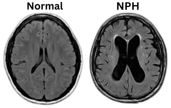 Normal Pressure Hydrocephalus (NPH)