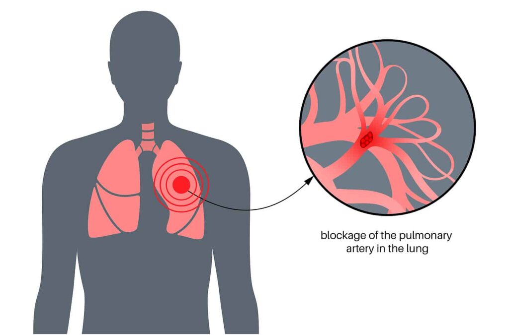 pulmonary embolism