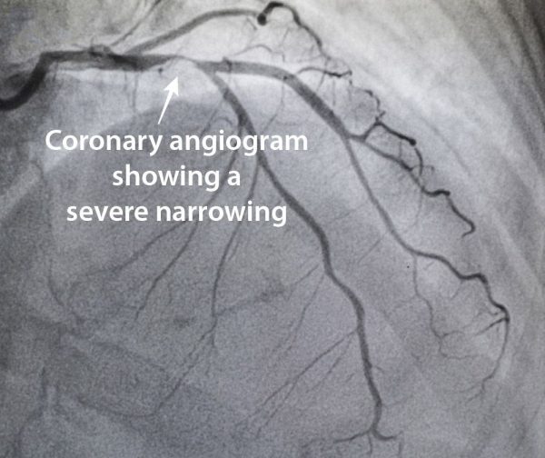 Coronary Angiography