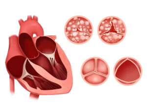 Heart Valve Stenosis