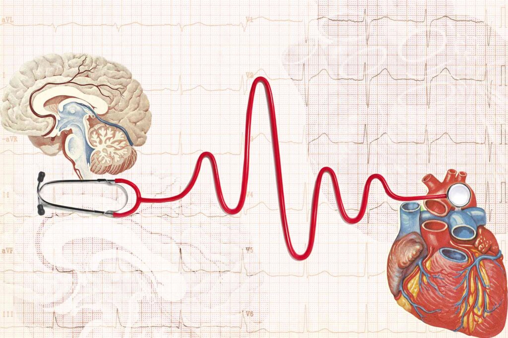 Stroke Protocol