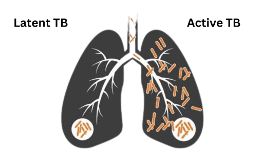 Types of Tuberculosis