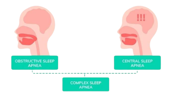 Types of Sleep Apnea