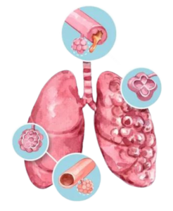 causes Interstitial Lung Disease (ILD)