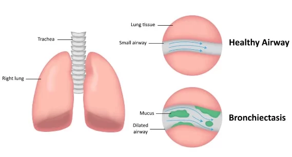 bronchiectasis