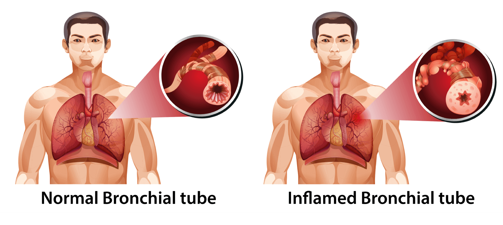 Chronic Obstructive Pulmonary Disease Copd Universal Hospital