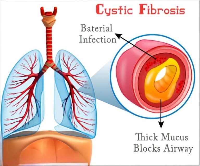 Cystic Fibrosis