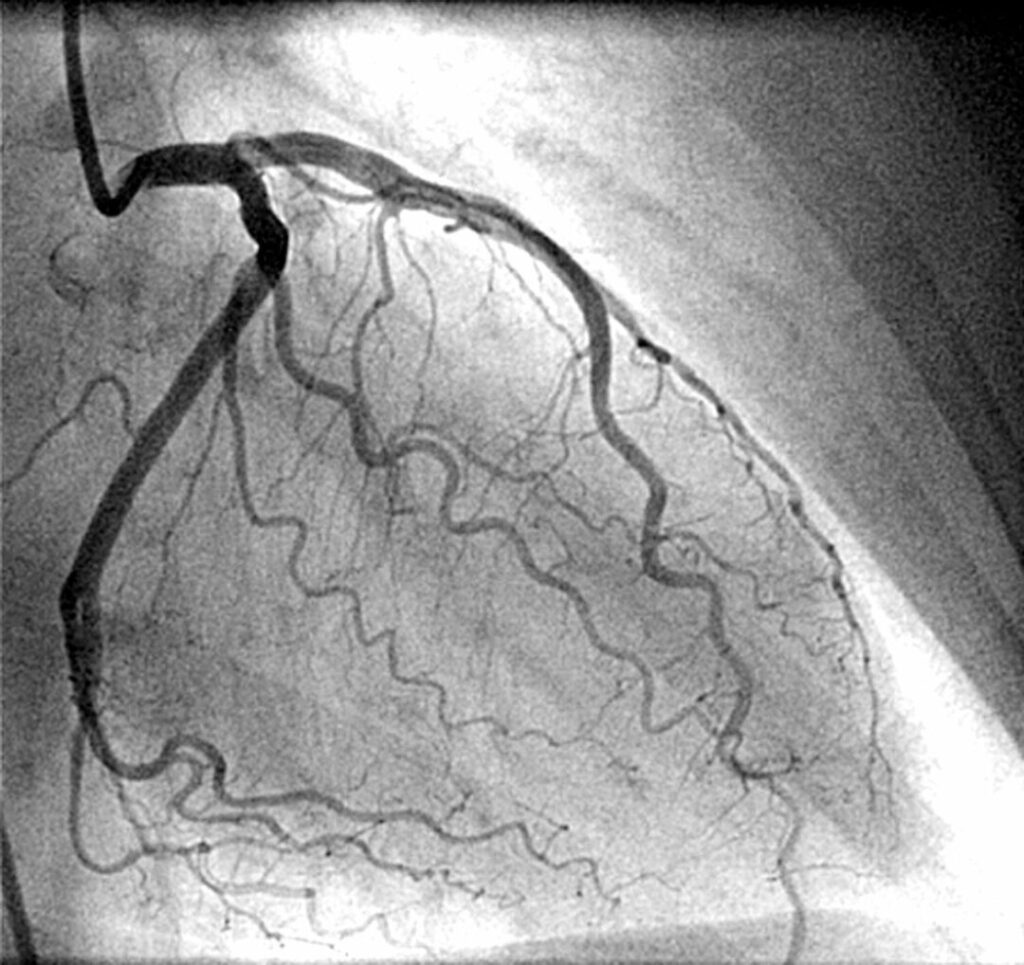 complex Angiography