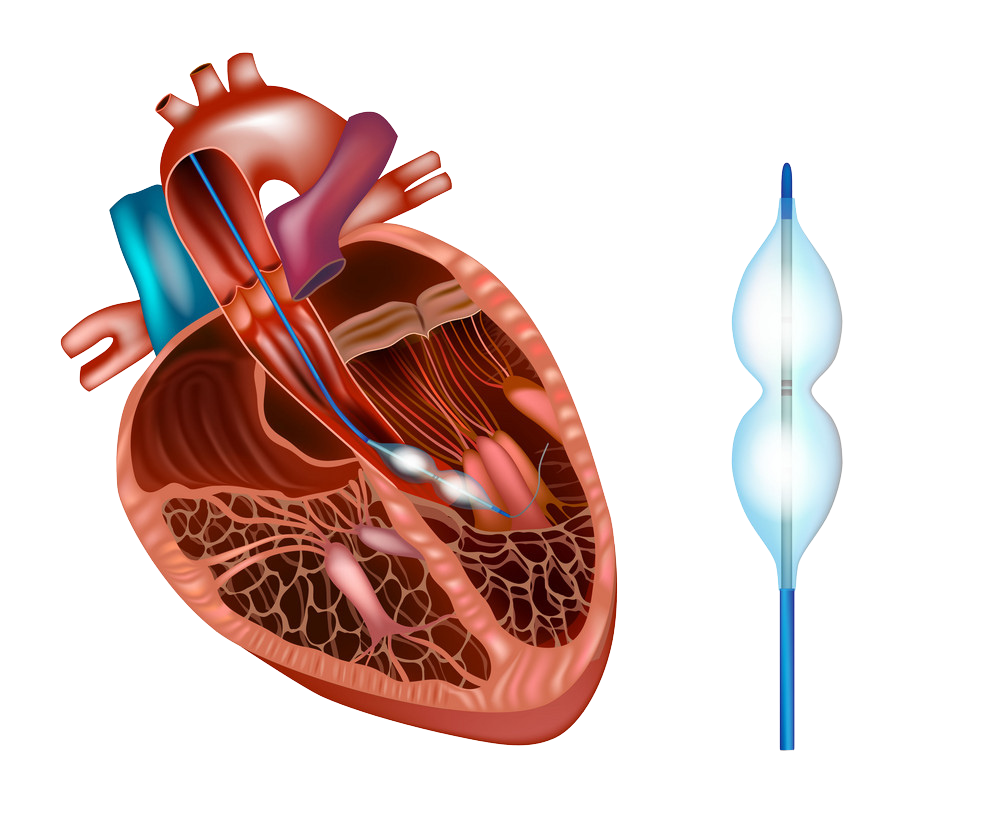 Balloon Aortic Valvotomy (BAV)