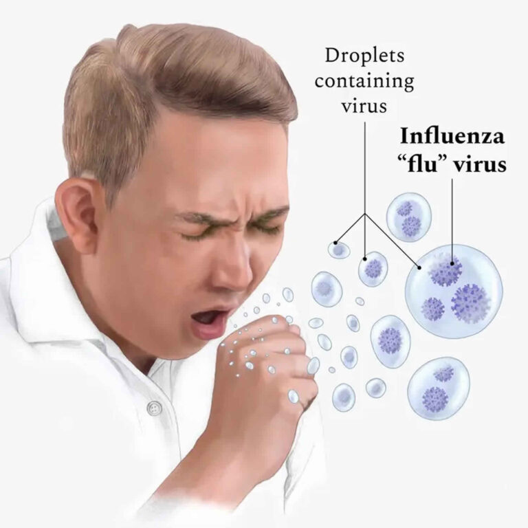 Influenza (Flu)