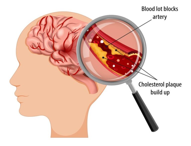 stroke intervention