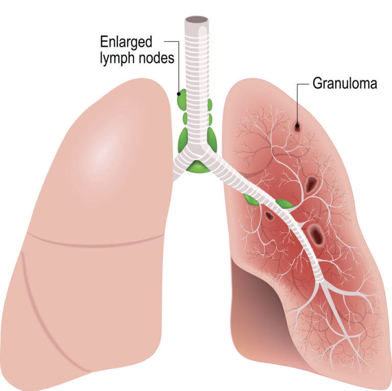 Sarcoidosis.