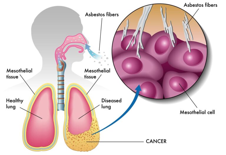 Asbestosis