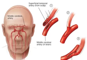 Moyamoya Disease