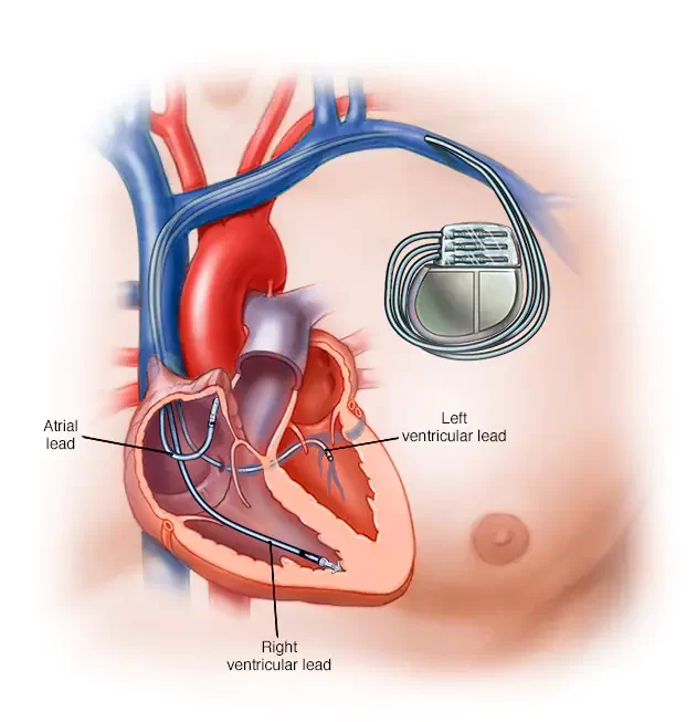 The pacemaker Implantation Procedure