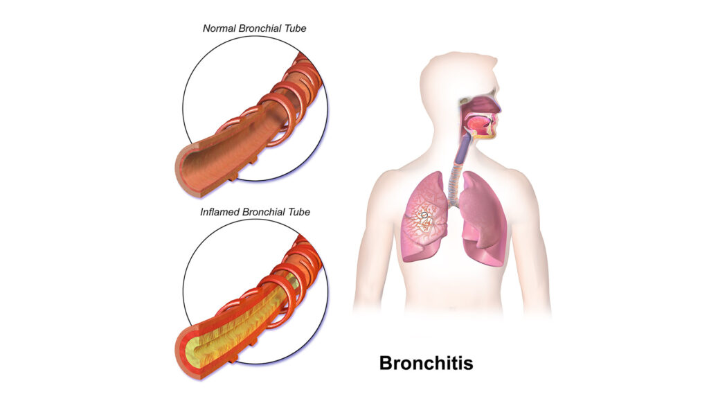 Bronchitis – Universal Hospital