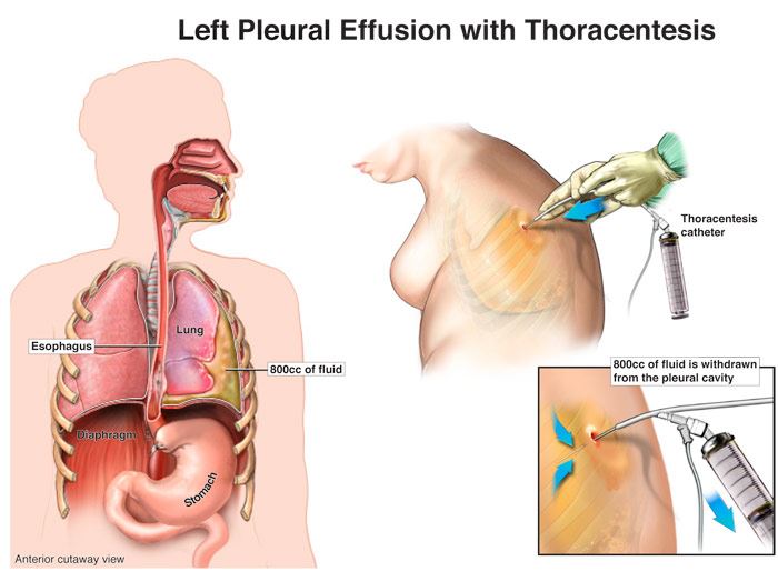 treatment of pleural effusion