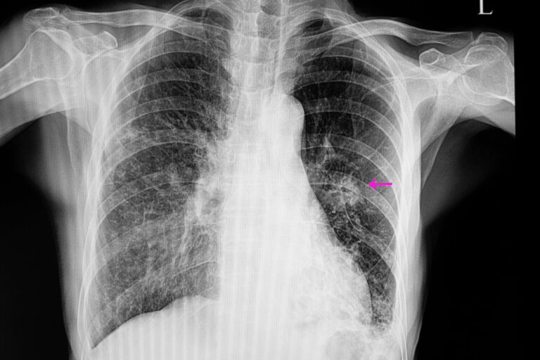 Pneumonia Treatment