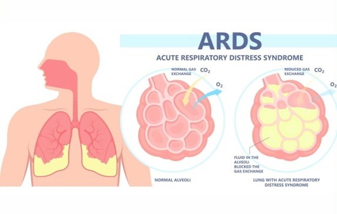 Acute Respiratory Distress Syndrome (ARDS)