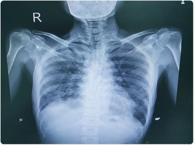 interstitial lung disease (ild) types