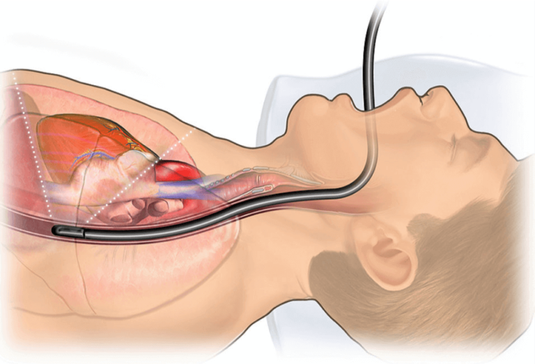 The TEE Procedure