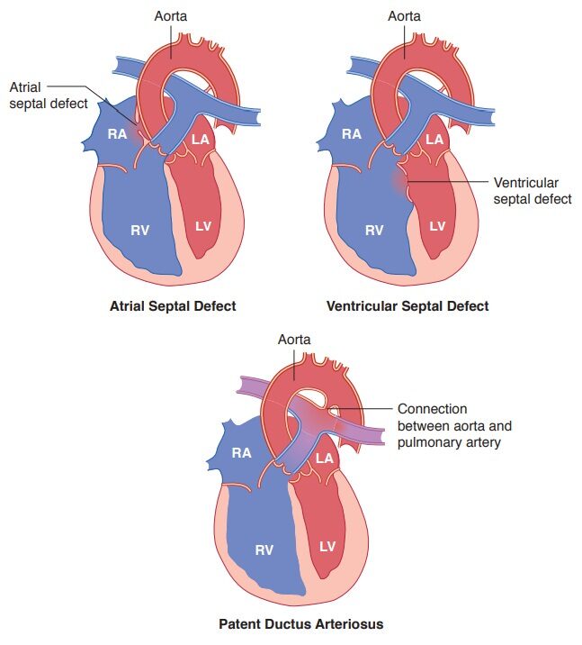 Understanding ASD, VSD, and PDA