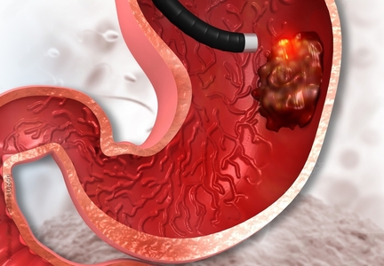 Gastric Cancer endoscopy