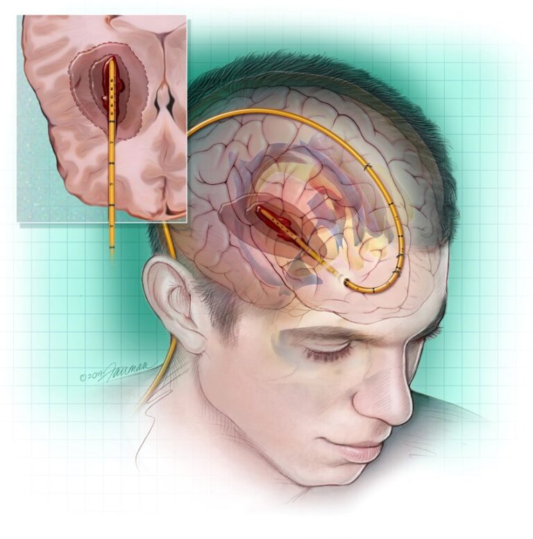 Neurovascular Surgery