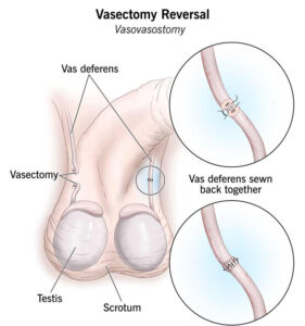 Vasectomy Reversal