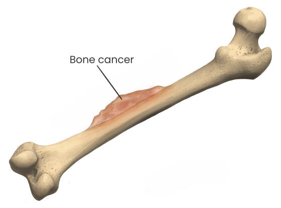 Bone Cancer