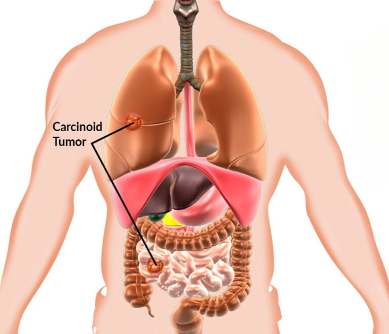 Neuroendocrine Tumors