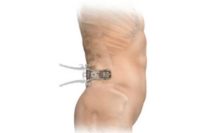 Lumbar Spine Surgery