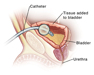 Bladder Surgery