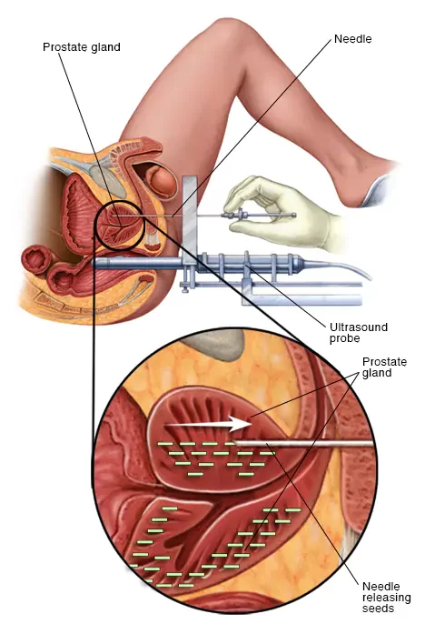 Brachytherapy